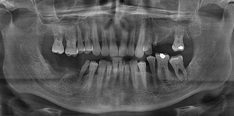 Implantologia in titanio osteointegrato Re di Roma