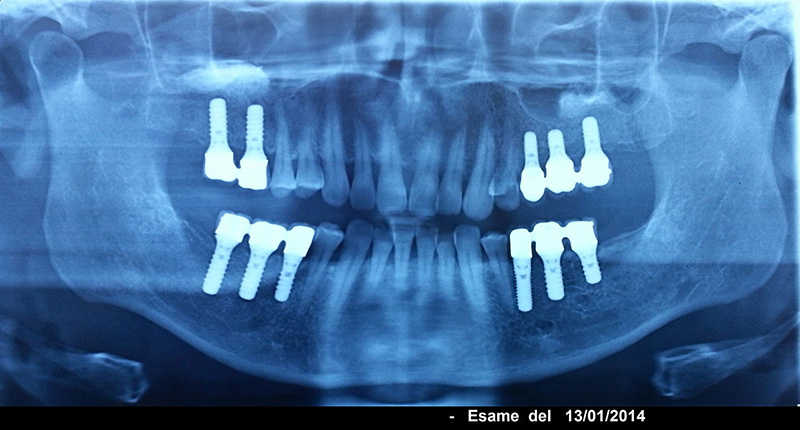Implantologia dentale Roma